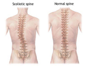 Scoliosis Surgery in India with top class medical care facilities